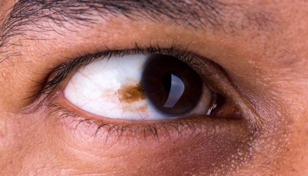 Precauciones para prevenir el cáncer de ojo
